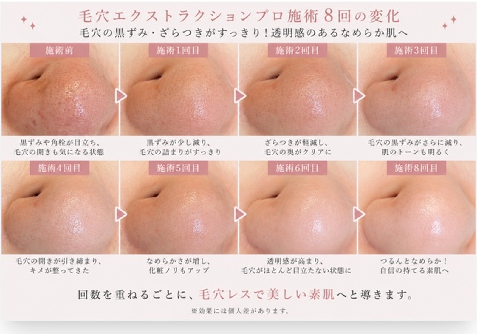 平野 エステ【サラスバティ】 |毛穴エクストラクションの効果写真、結果写真
